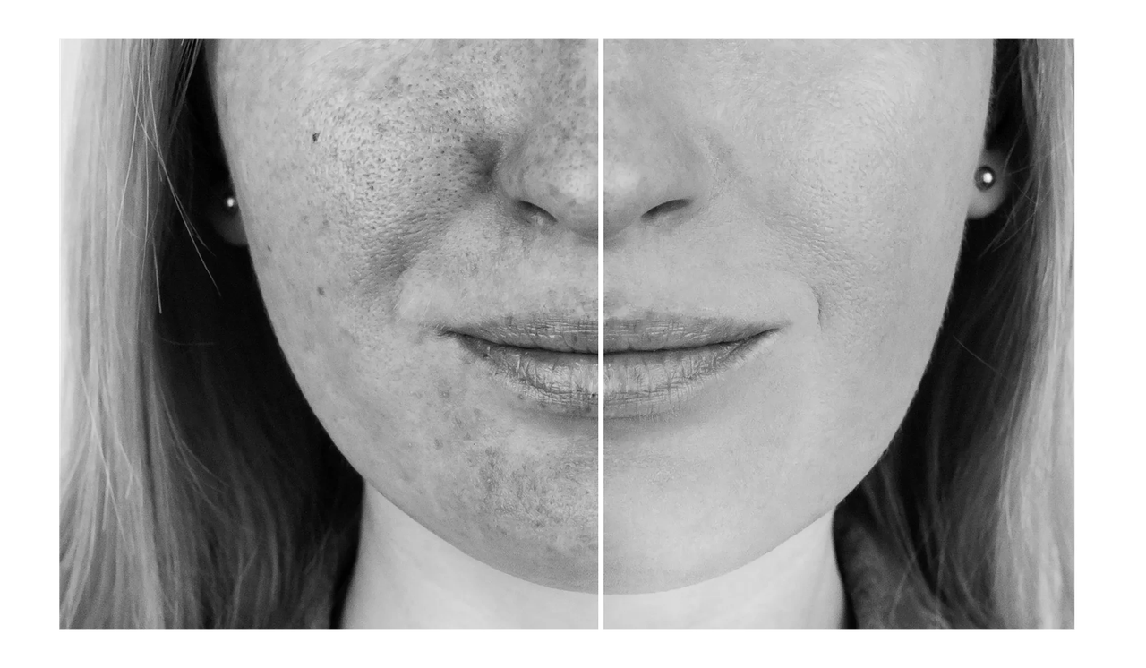 Comparison of dark spots and melasma on facial skin, treated at VIV Wellness in Dallas