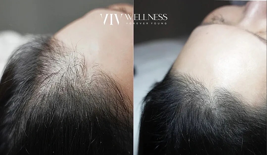 Before and after hair restoration results at VIV Wellness