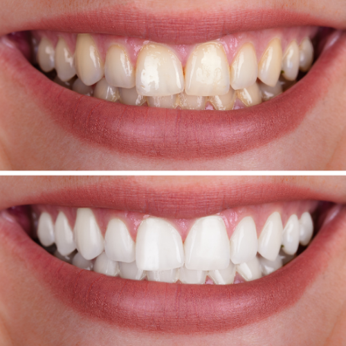 Close-up of two smiles showing tooth shape and wear
