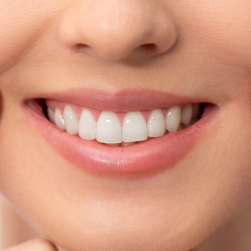 Bright, healthy smile after professional teeth whitening at Densley Dental in Henderson NV