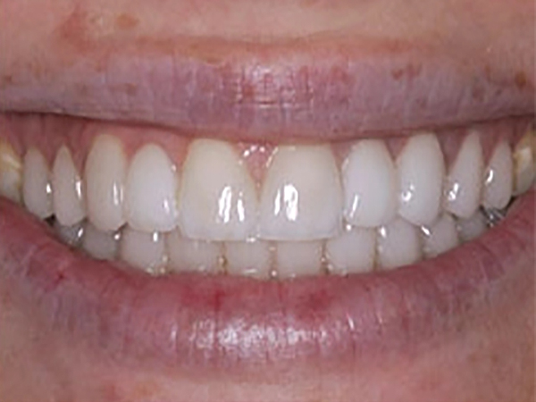 After a porcelain bridge at Densley Dental in Henderson NV, case 5