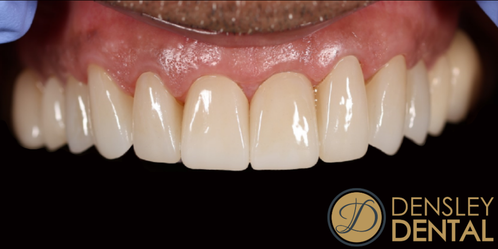 After porcelain veneers at Densley Dental in Henderson NV, case 3