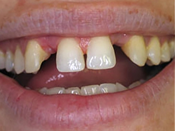 Before a porcelain bridge at Densley Dental in Henderson NV, case 5
