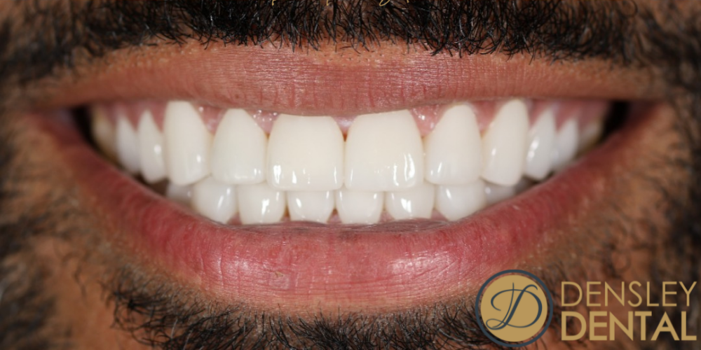 After porcelain veneers at Densley Dental in Henderson NV, case 2