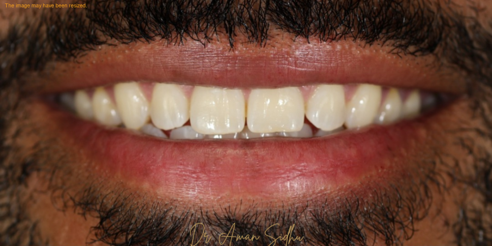 Before porcelain veneers at Densley Dental in Henderson NV, case 2