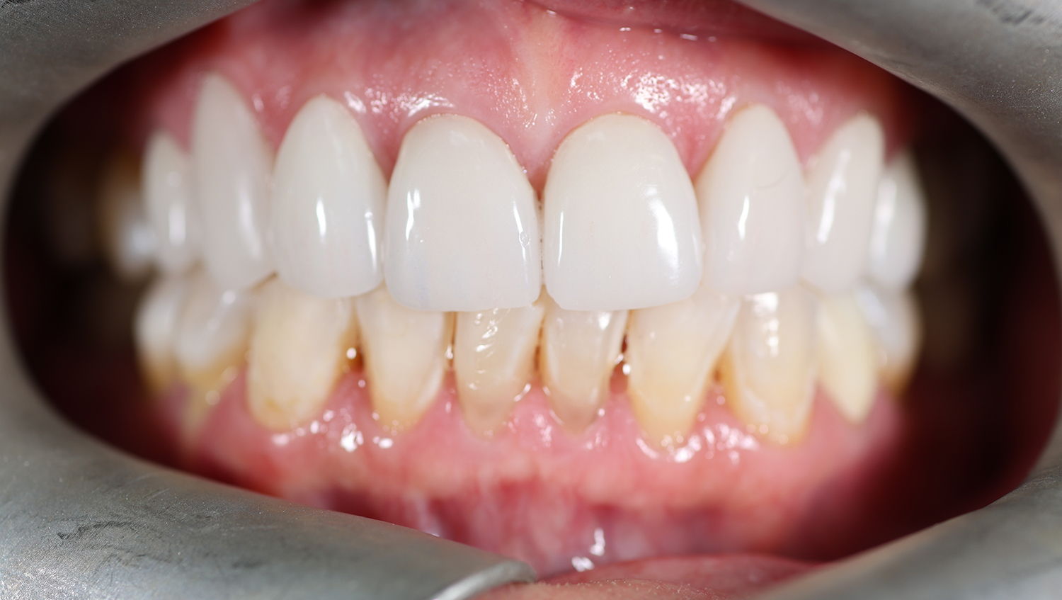 After porcelain veneers at Densley Dental in Henderson NV, case 1