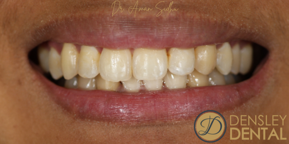 After Invisalign treatment at Densley Dental in Henderson NV, case 4