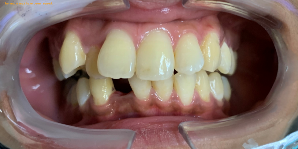 Before Invisalign treatment at Densley Dental in Henderson NV, case 4