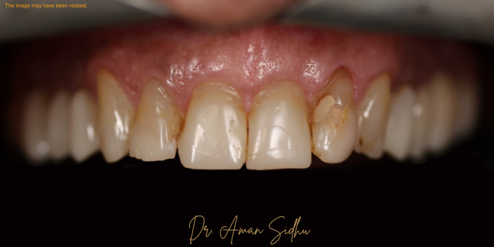 Before porcelain veneers at Densley Dental in Henderson NV, case 3