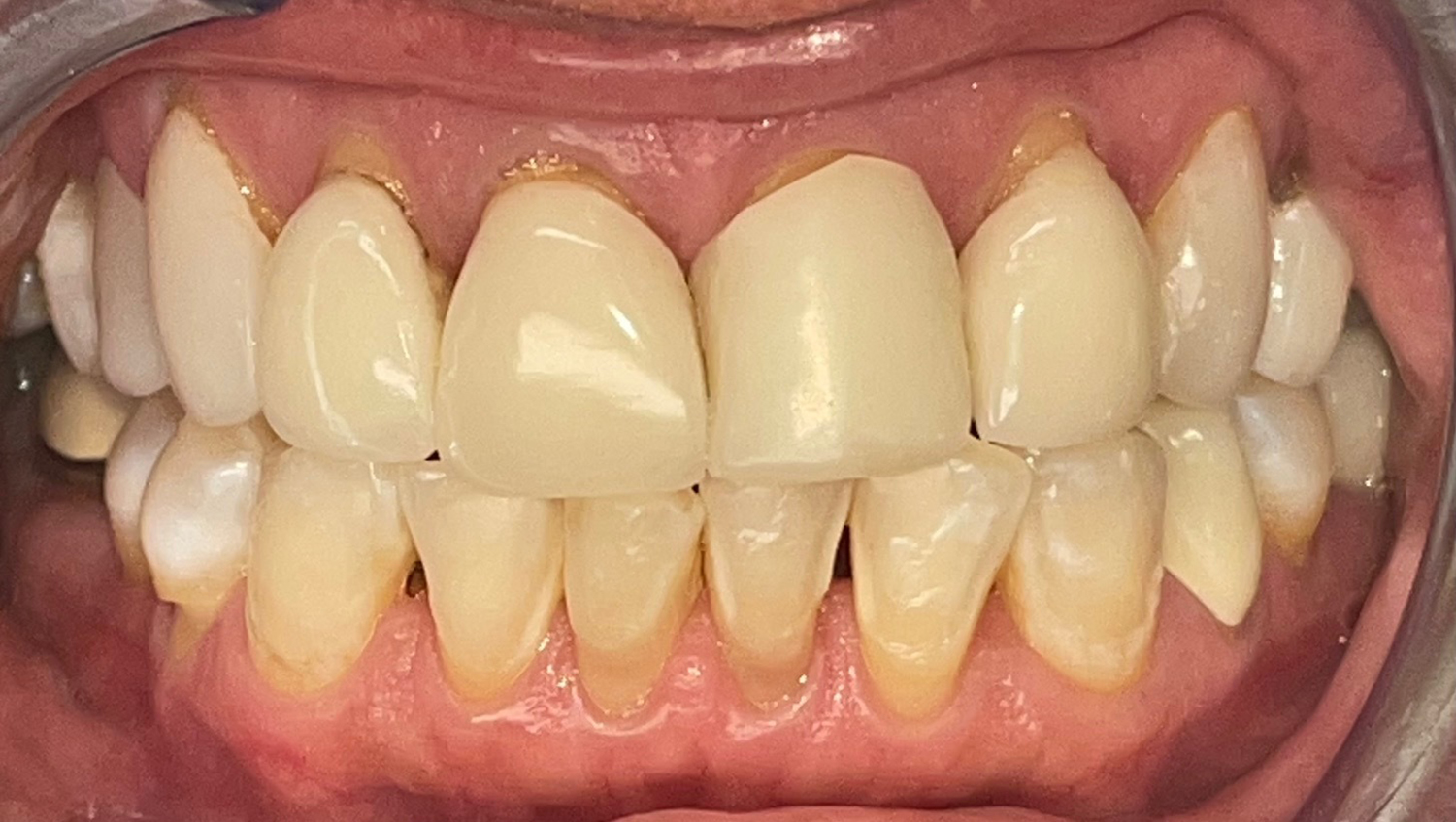Before porcelain veneers at Densley Dental in Henderson NV, case 1
