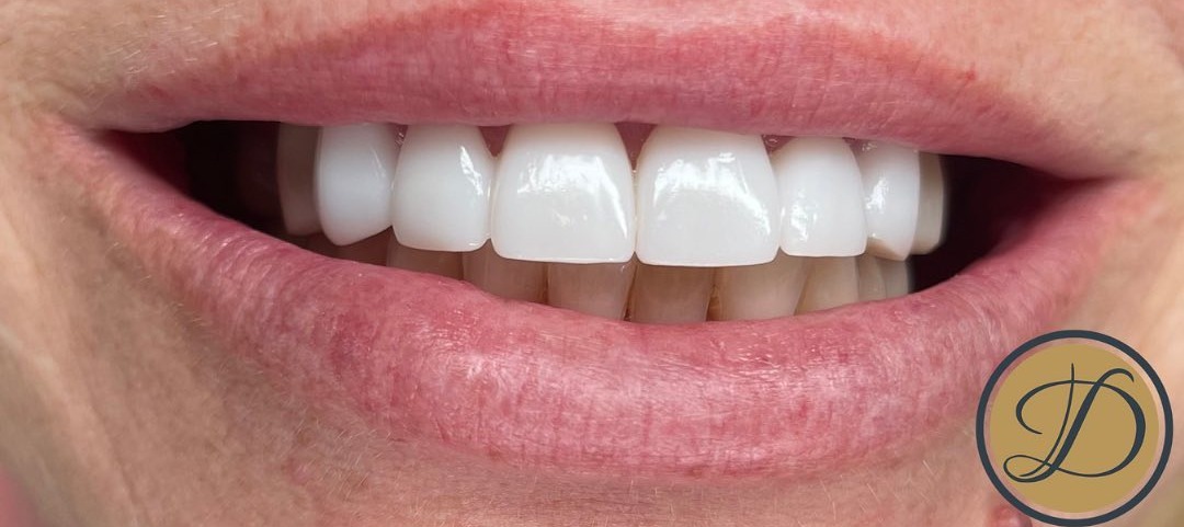 After porcelain veneers at Densley Dental in Henderson NV, case 10