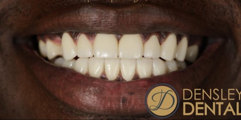 After porcelain veneers at Densley Dental in Henderson NV, case 7