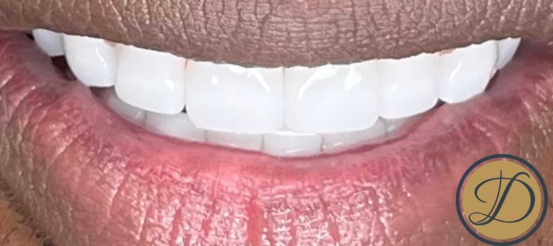 After porcelain veneers at Densley Dental in Henderson NV, case 9