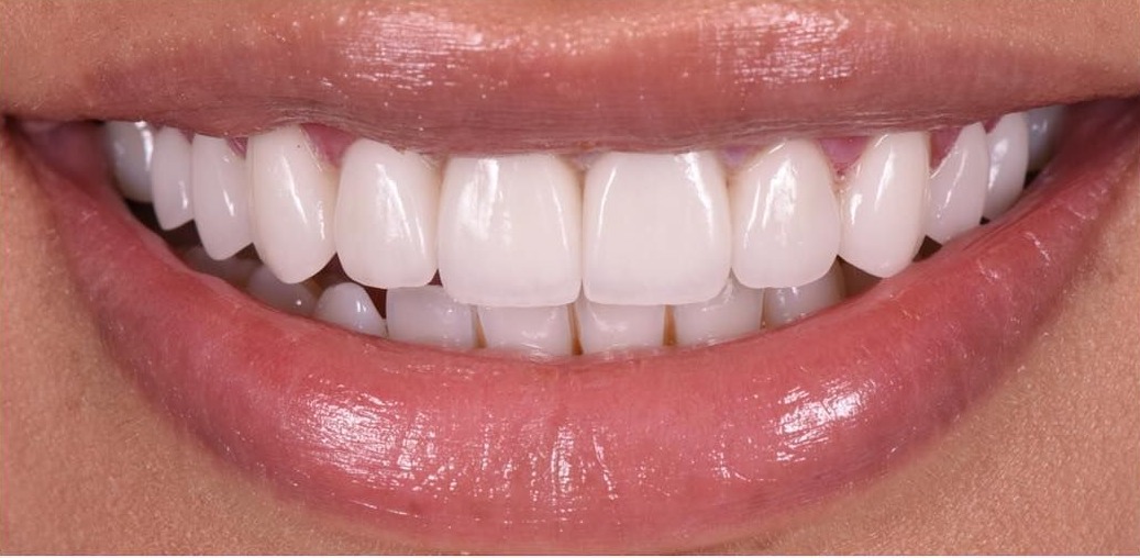 After porcelain veneers at Densley Dental in Henderson NV, case 8