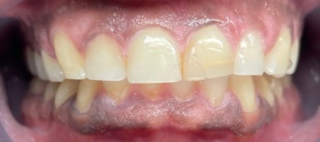 Before porcelain veneers at Densley Dental in Henderson NV, case 9