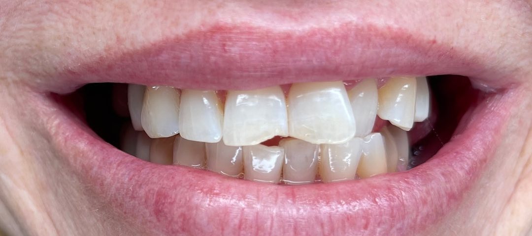 Before porcelain veneers at Densley Dental in Henderson NV, case 10