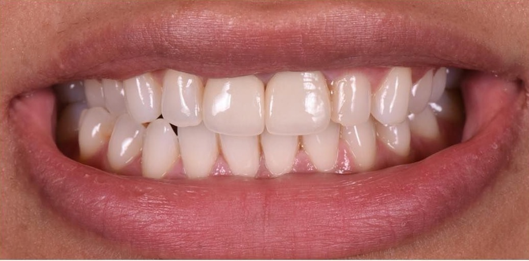 Before porcelain veneers at Densley Dental in Henderson NV, case 8