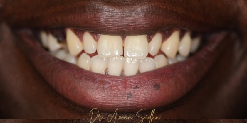 Before porcelain veneers at Densley Dental in Henderson NV, case 7