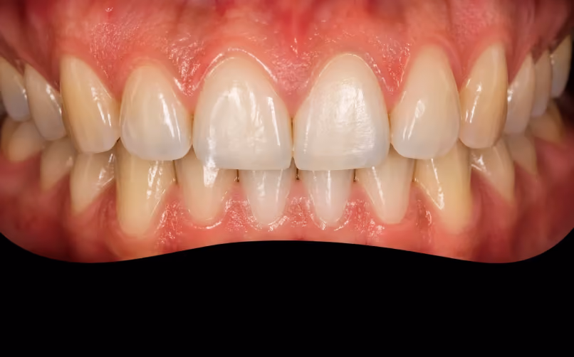 Close-up of upper and lower teeth with red gums showing mild crowding and slight spacing between the front upper teeth.