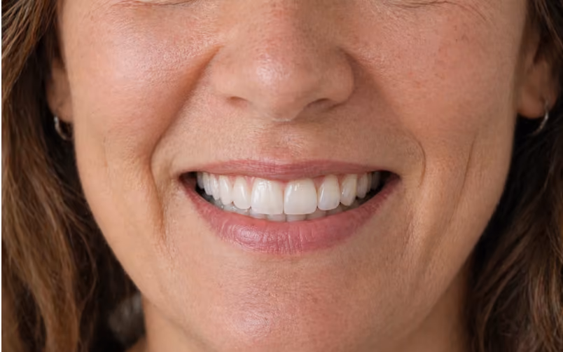 Close-up of a woman's smiling mouth showing white teeth and natural lips with light wrinkles around the mouth and nose.