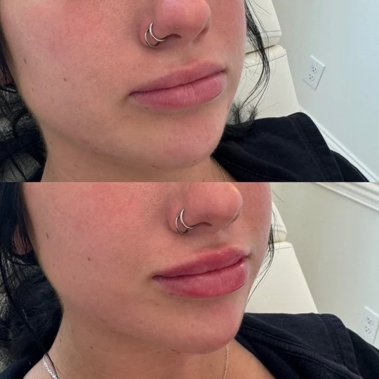 Two stacked close-up photographs of lips from the Rouge Aesthetics procedure gallery