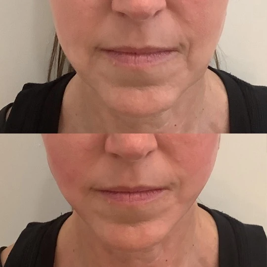 Two stacked photographs showing the lips and lower face from the Rouge Aesthetics procedure gallery