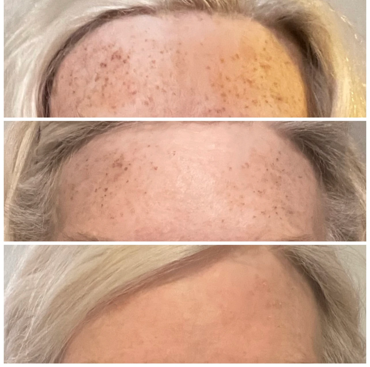 Three close-up views of a forehead from the Rouge Aesthetics procedure gallery
