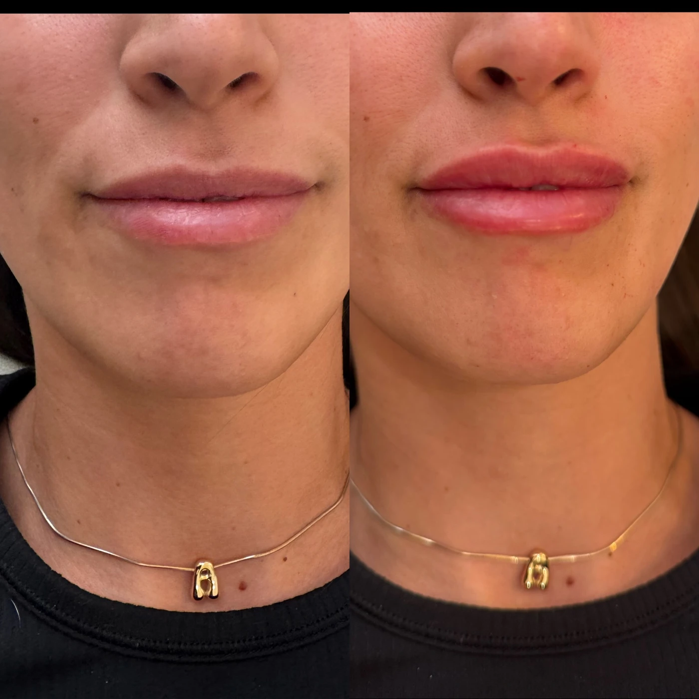 Side-by-side close-up photographs of lips from the Rouge Aesthetics procedure gallery