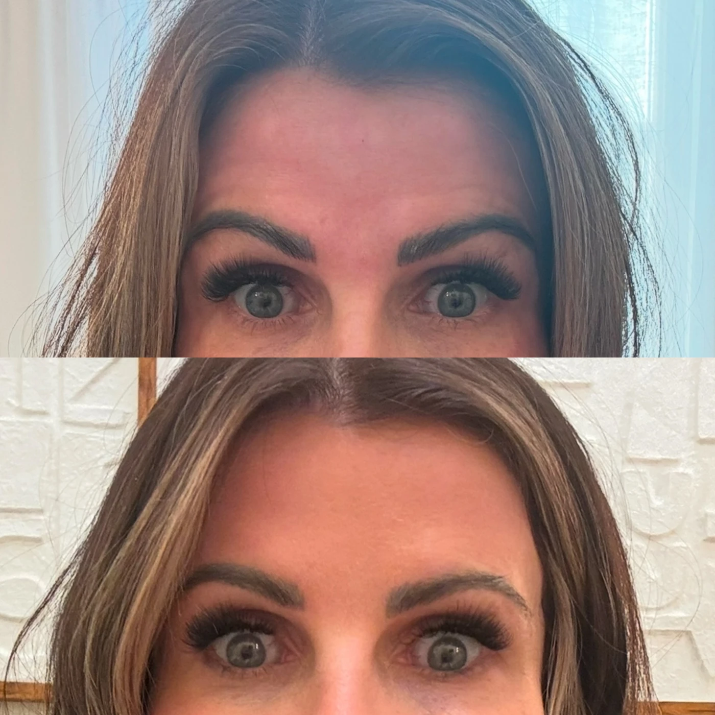 Two photographs of forehead expressions from the Rouge Aesthetics procedure gallery
