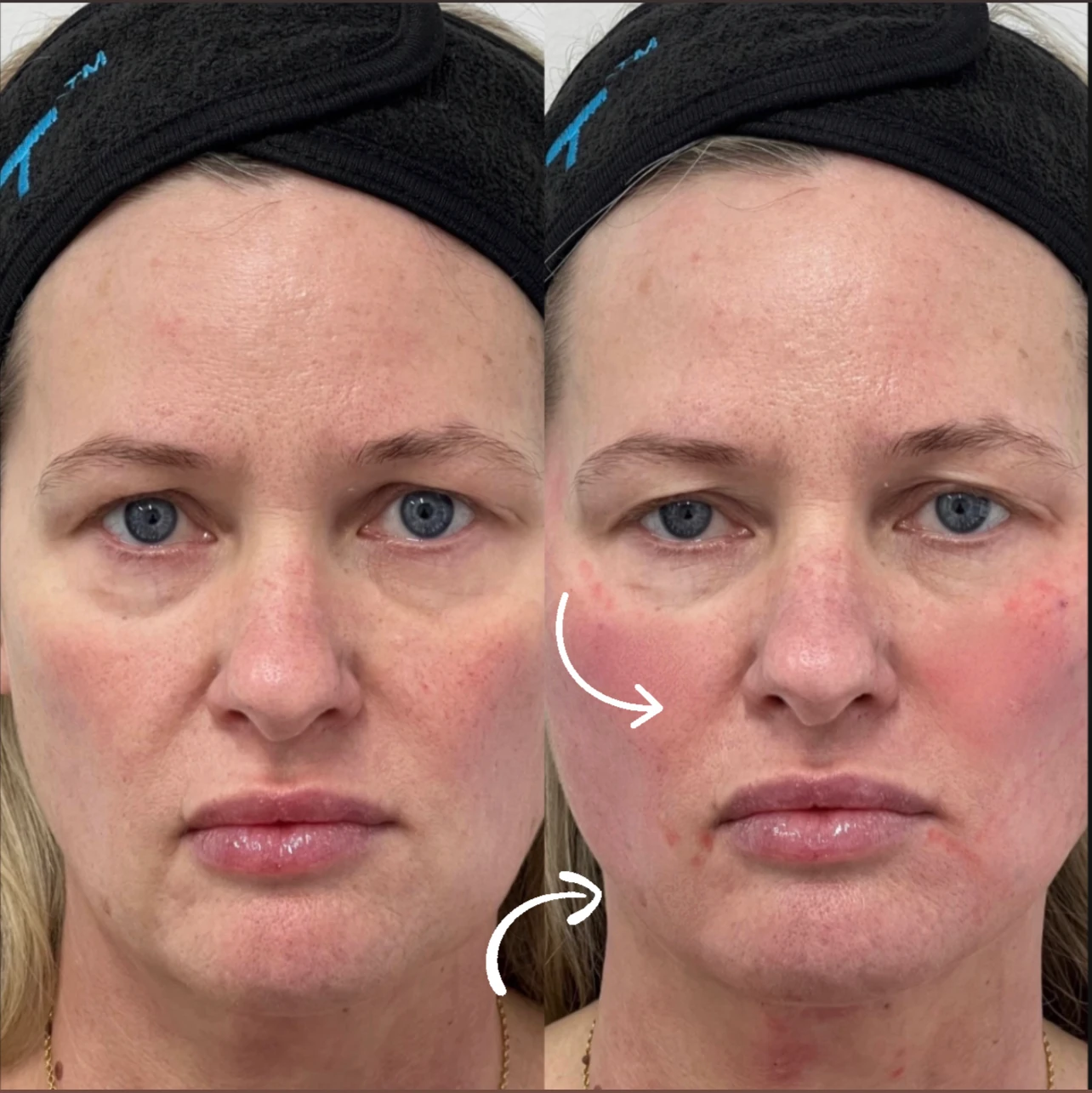 Side-by-side facial photographs with arrows supplied in the Rouge Aesthetics procedure gallery