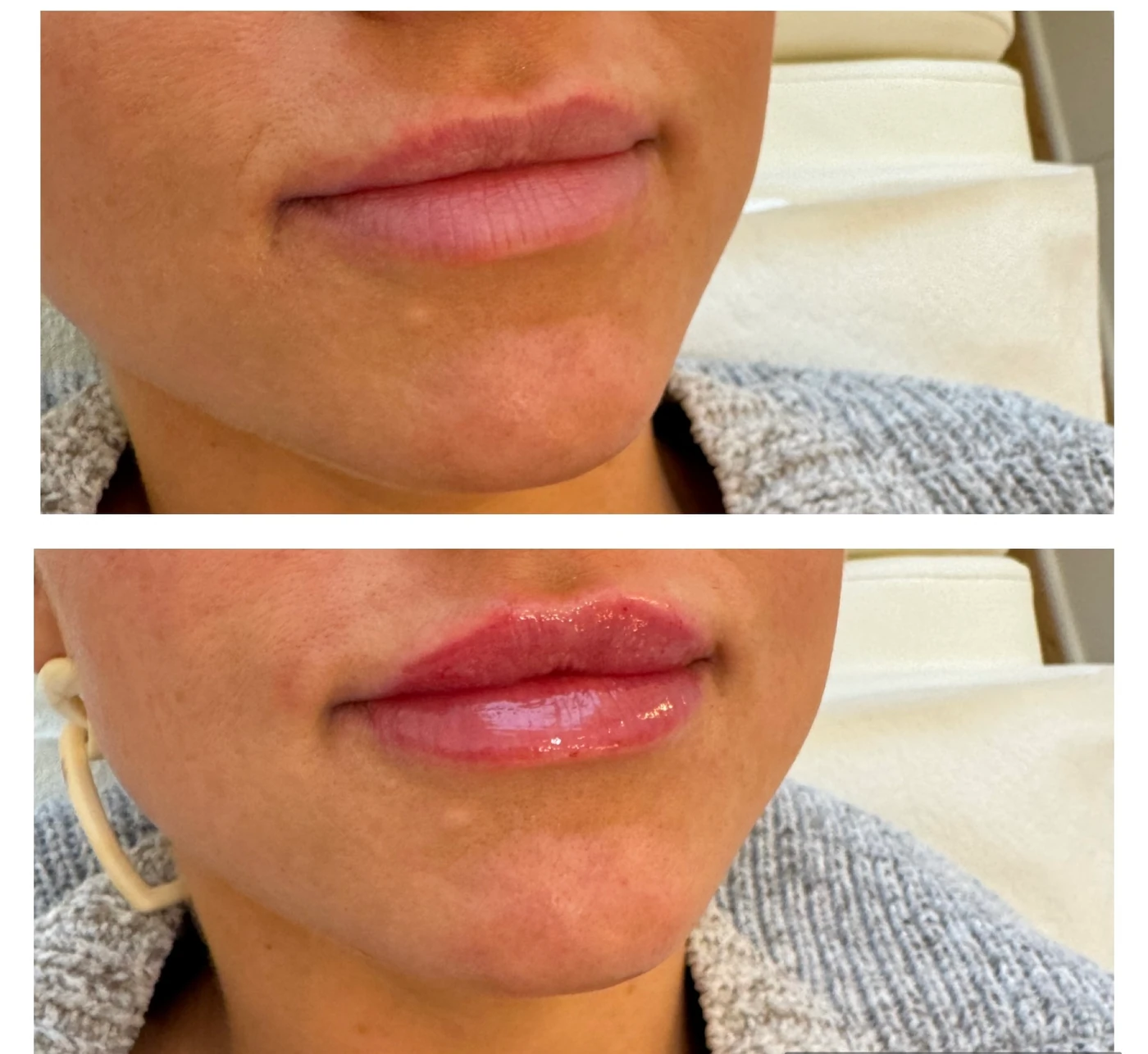 Two close-up views of lips arranged vertically in the Rouge Aesthetics procedure gallery