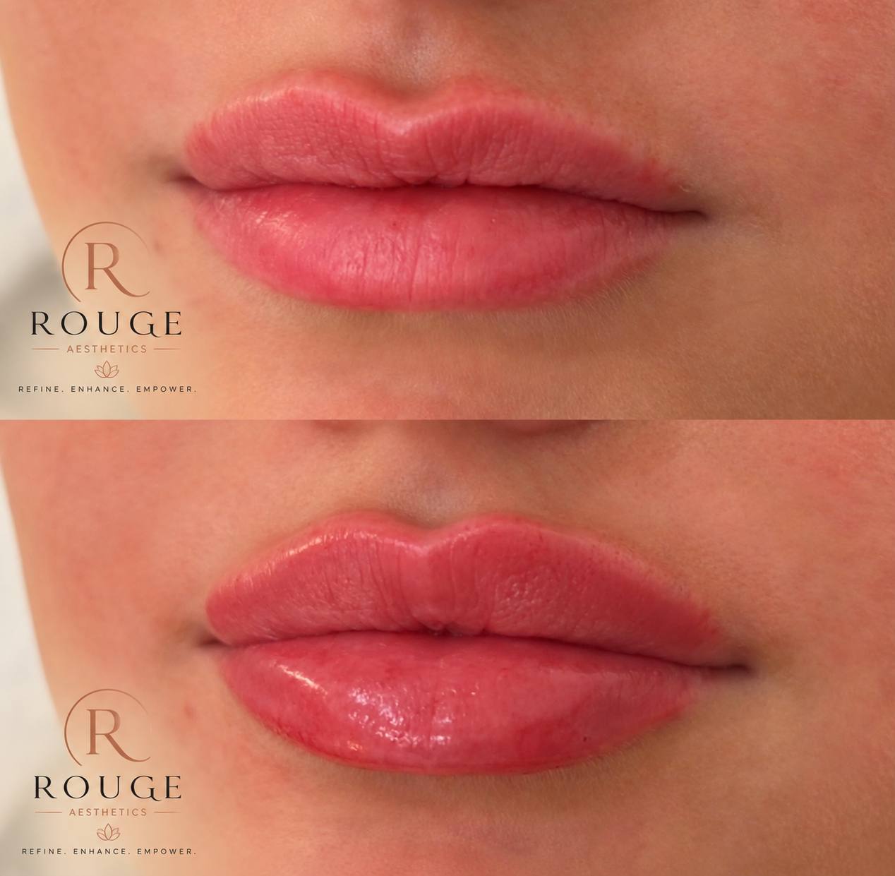 Side-by-side close-up photographs of lips from the Rouge Aesthetics procedure gallery