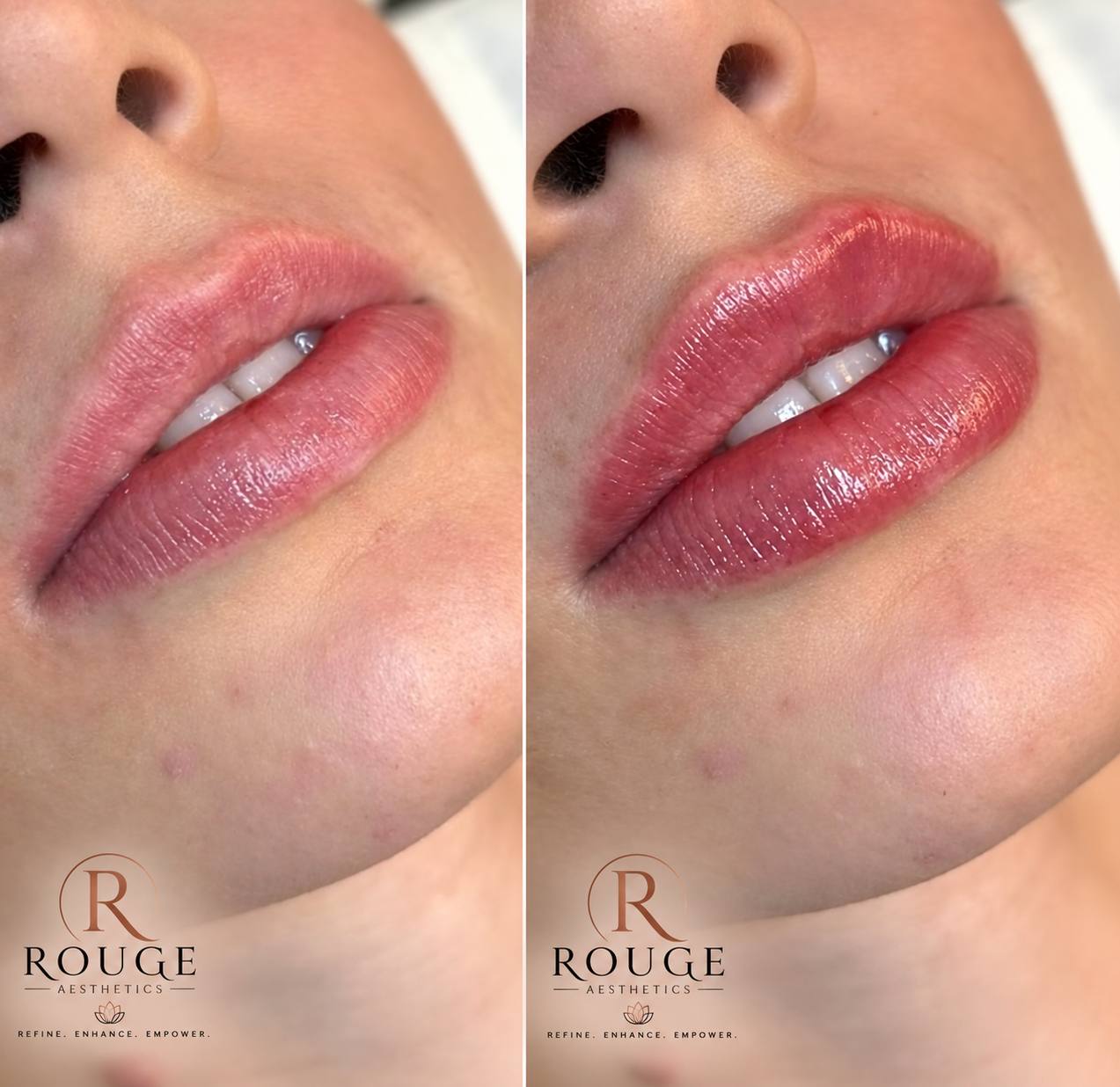 Two stacked close-up photographs of lips from the Rouge Aesthetics procedure gallery