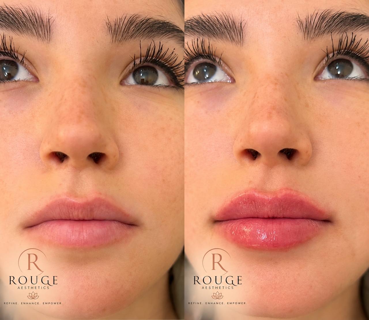 Side-by-side close-up photographs of lips from the Rouge Aesthetics procedure gallery