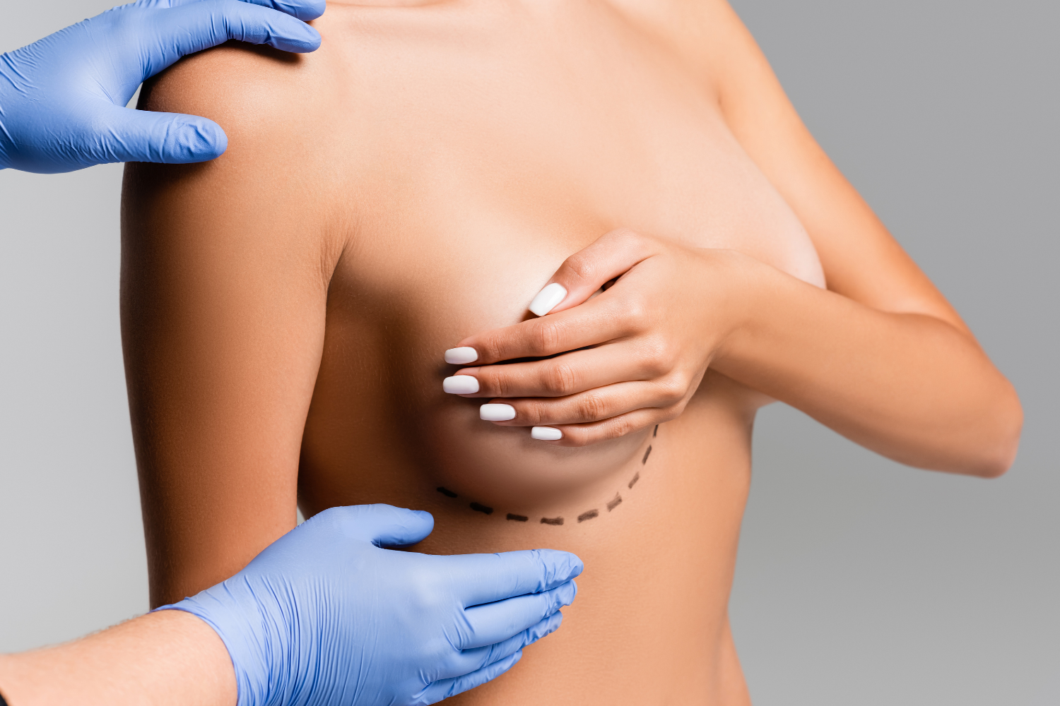 Breast Explant Recovery Time: Week-by-Week Guide