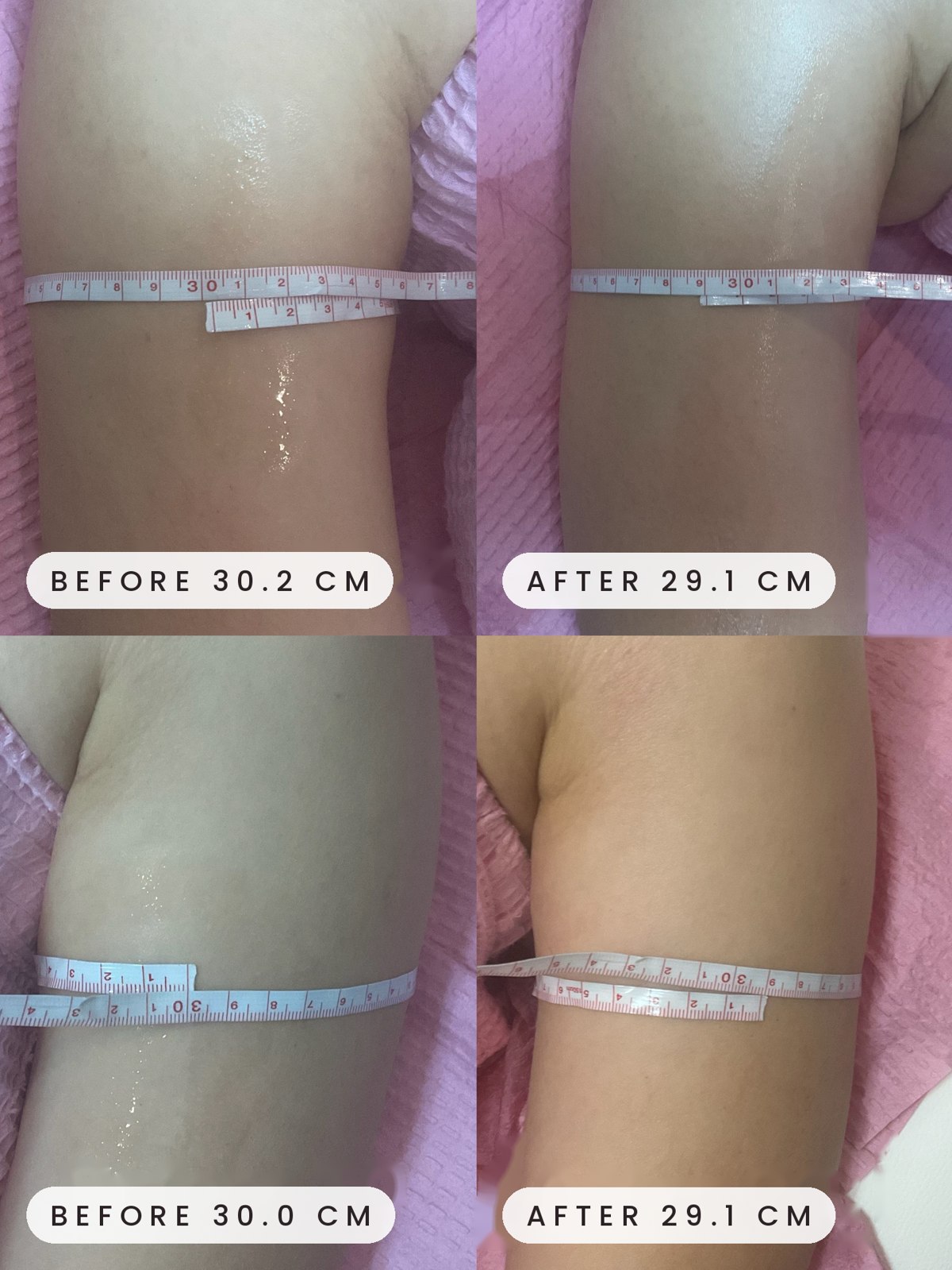 Onda Coolwaves arm circumference before and after
