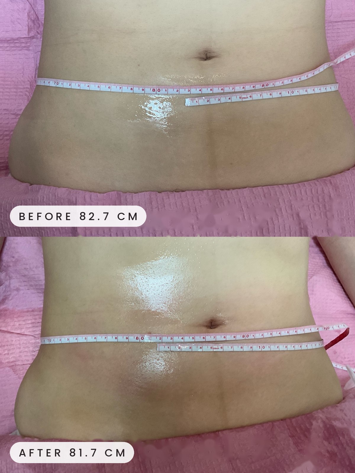 Onda Coolwaves body contouring before and after
