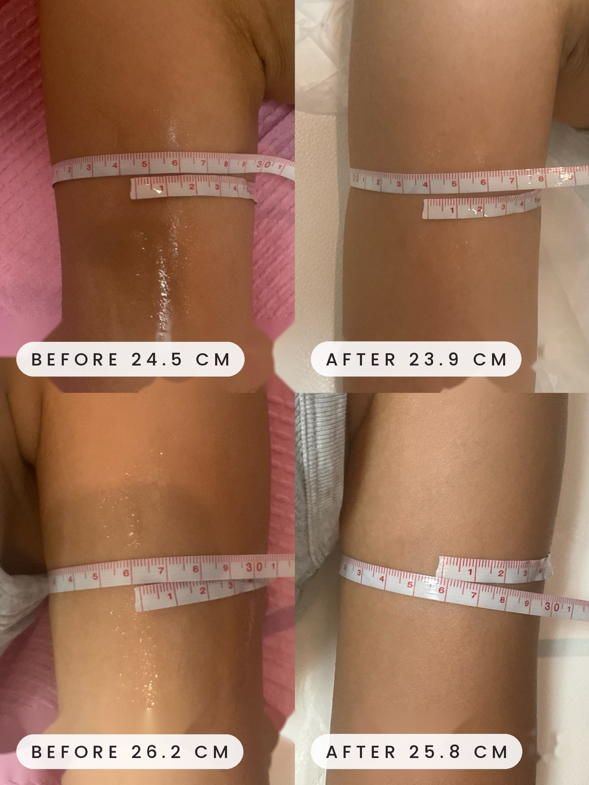 Onda Coolwaves upper arm before and after measurement