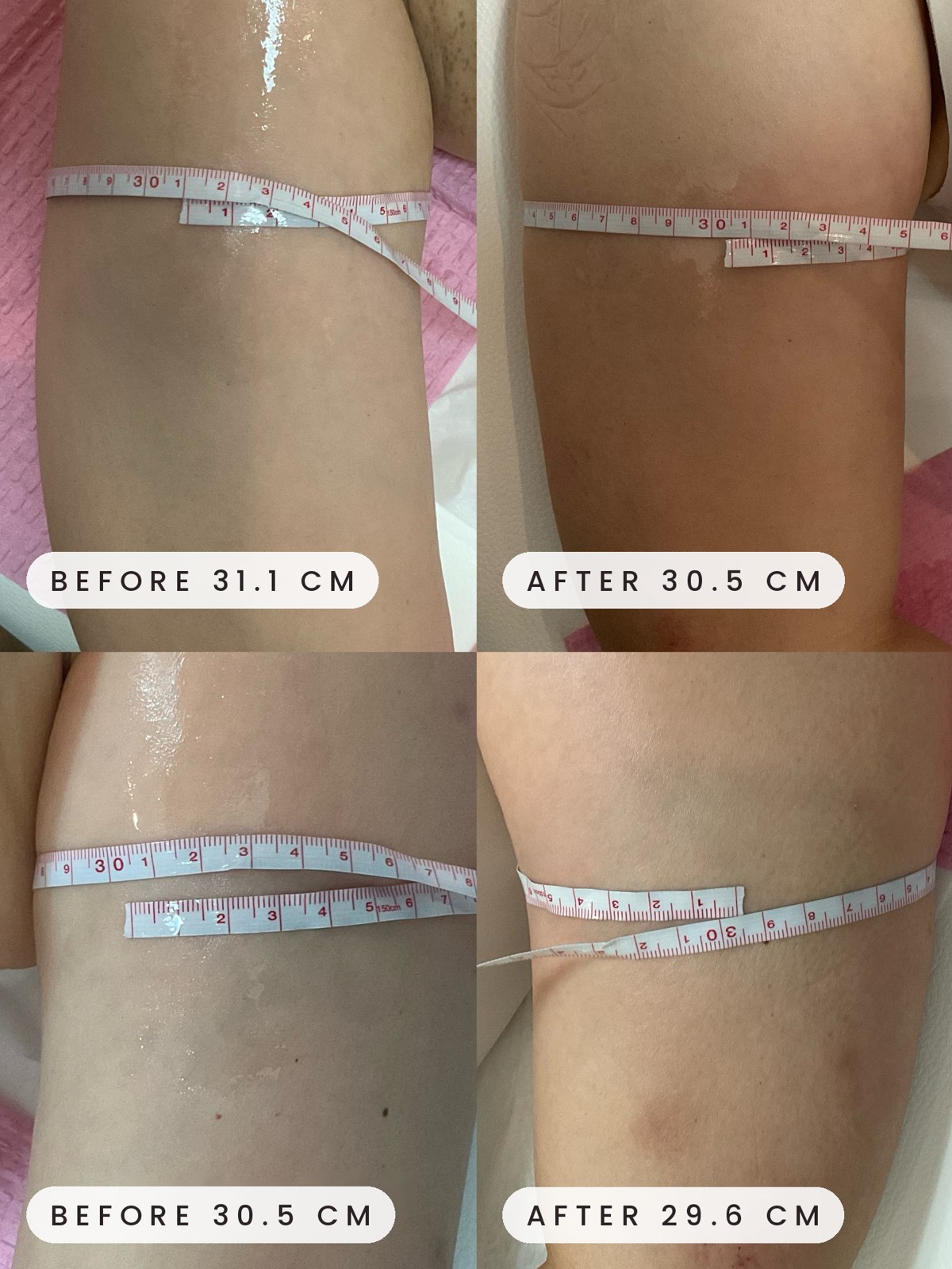 Onda Coolwaves thigh before and after measurement