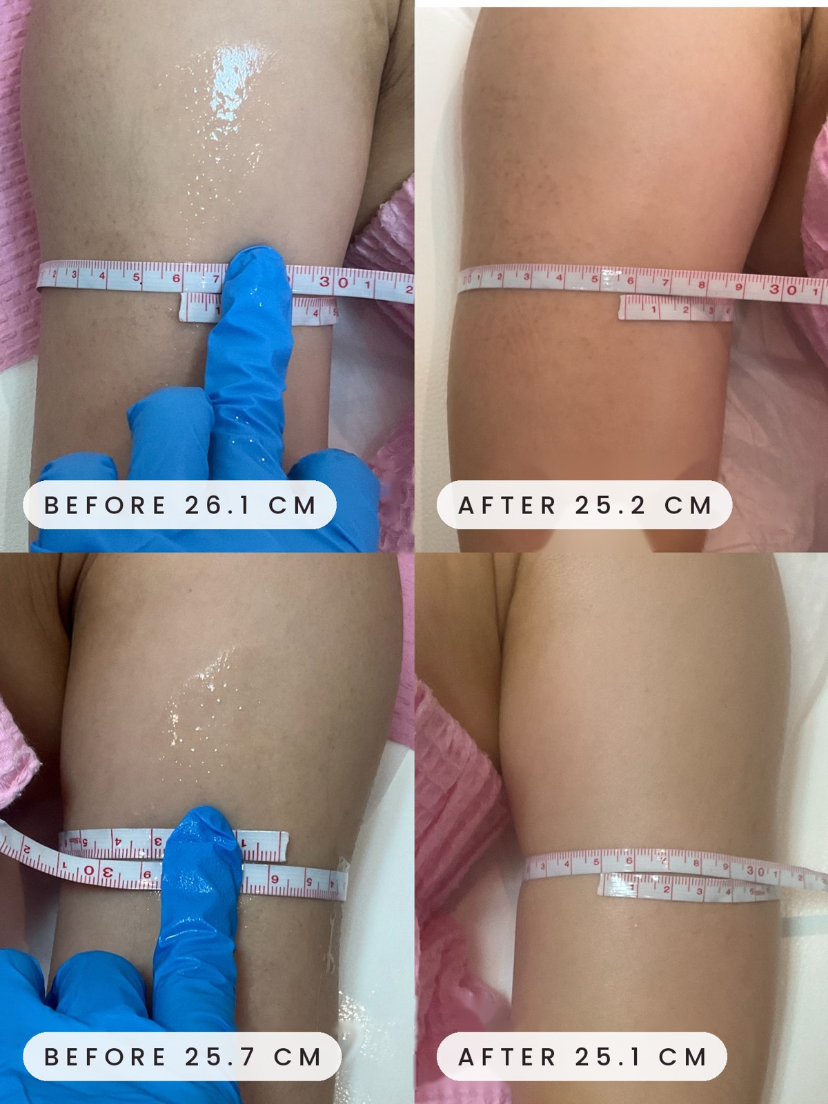 Onda body contouring result