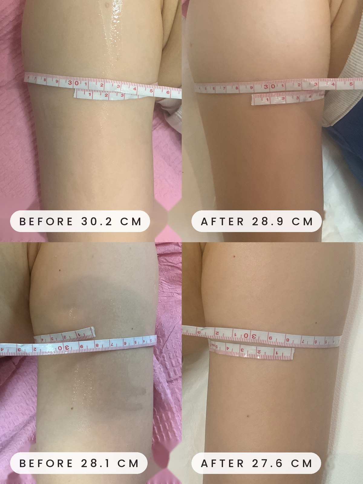 Onda upper arm before and after measurement