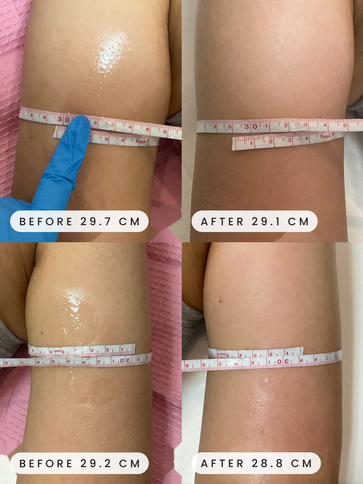 Onda body contouring result