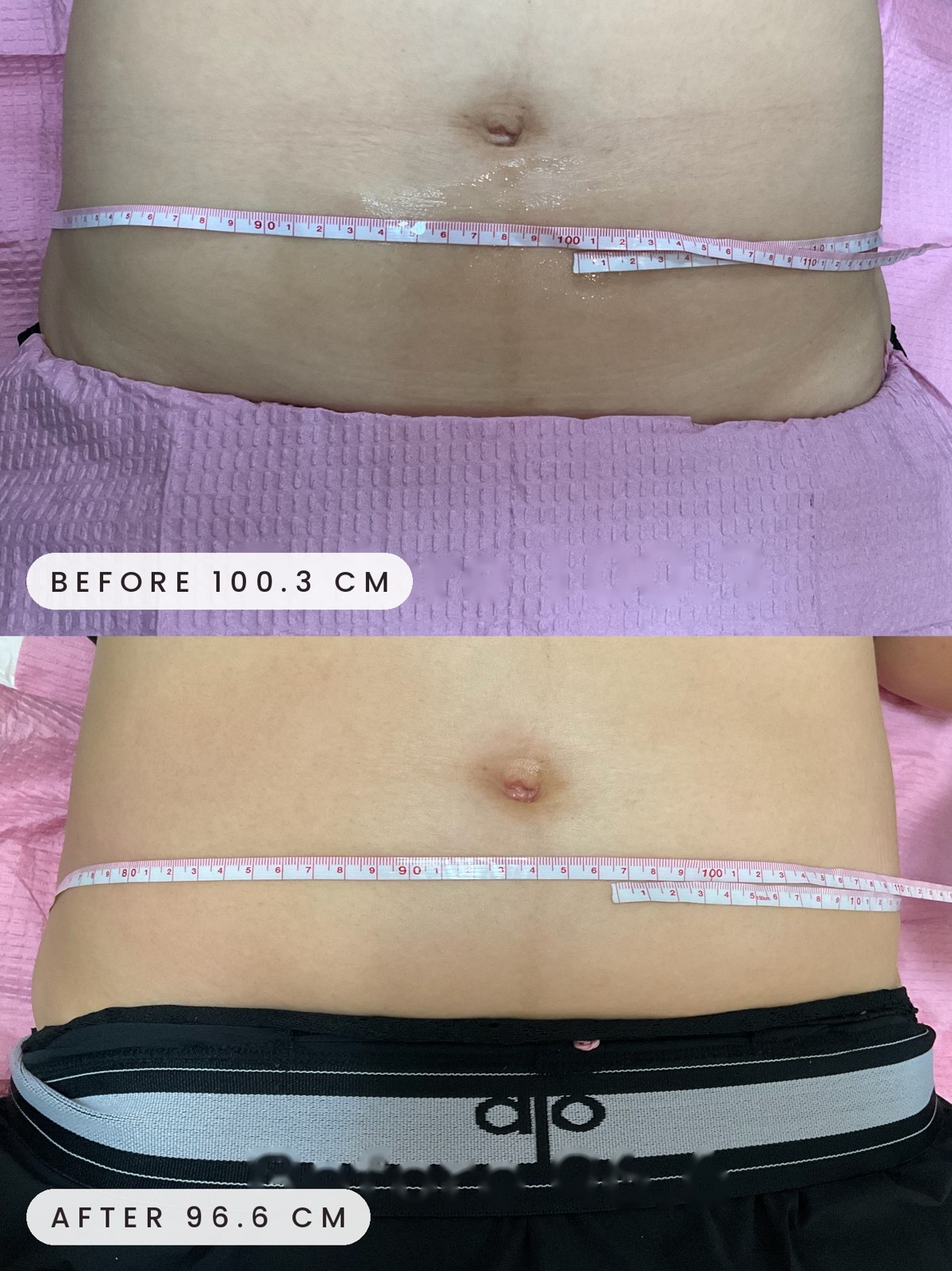 Onda abdomen before and after measurement