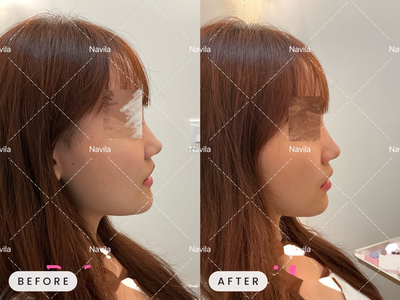 Juvederm before and after — profile