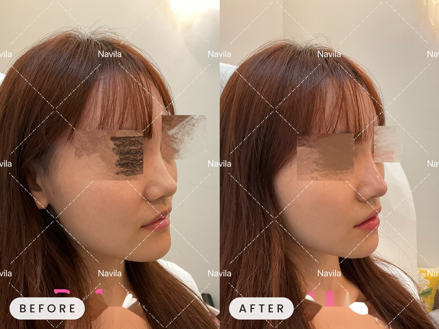 Juvederm before and after — profile