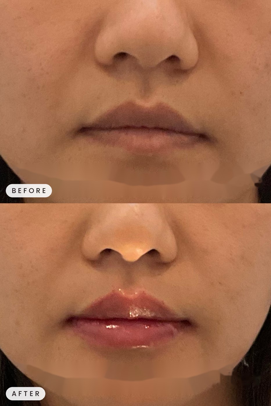 Juvederm lip filler before and after