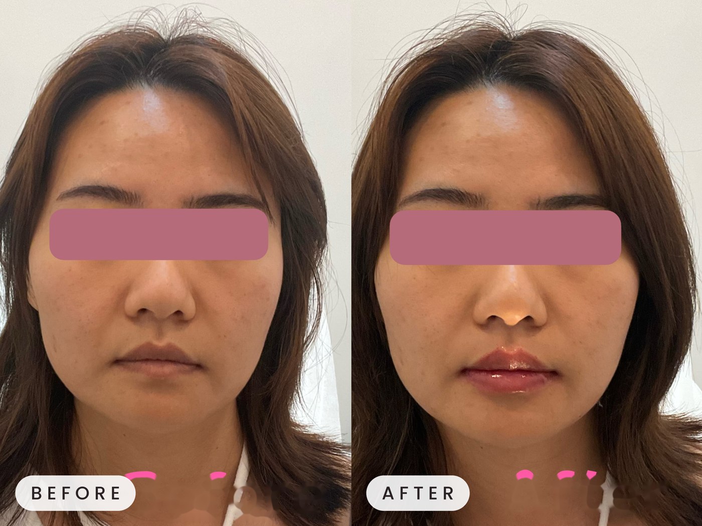 Juvederm filler result
