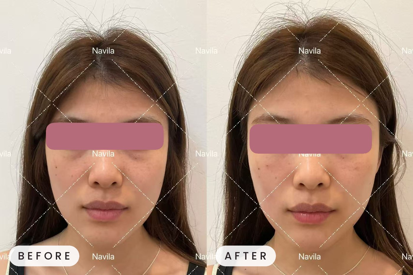 Juvelook skin booster result