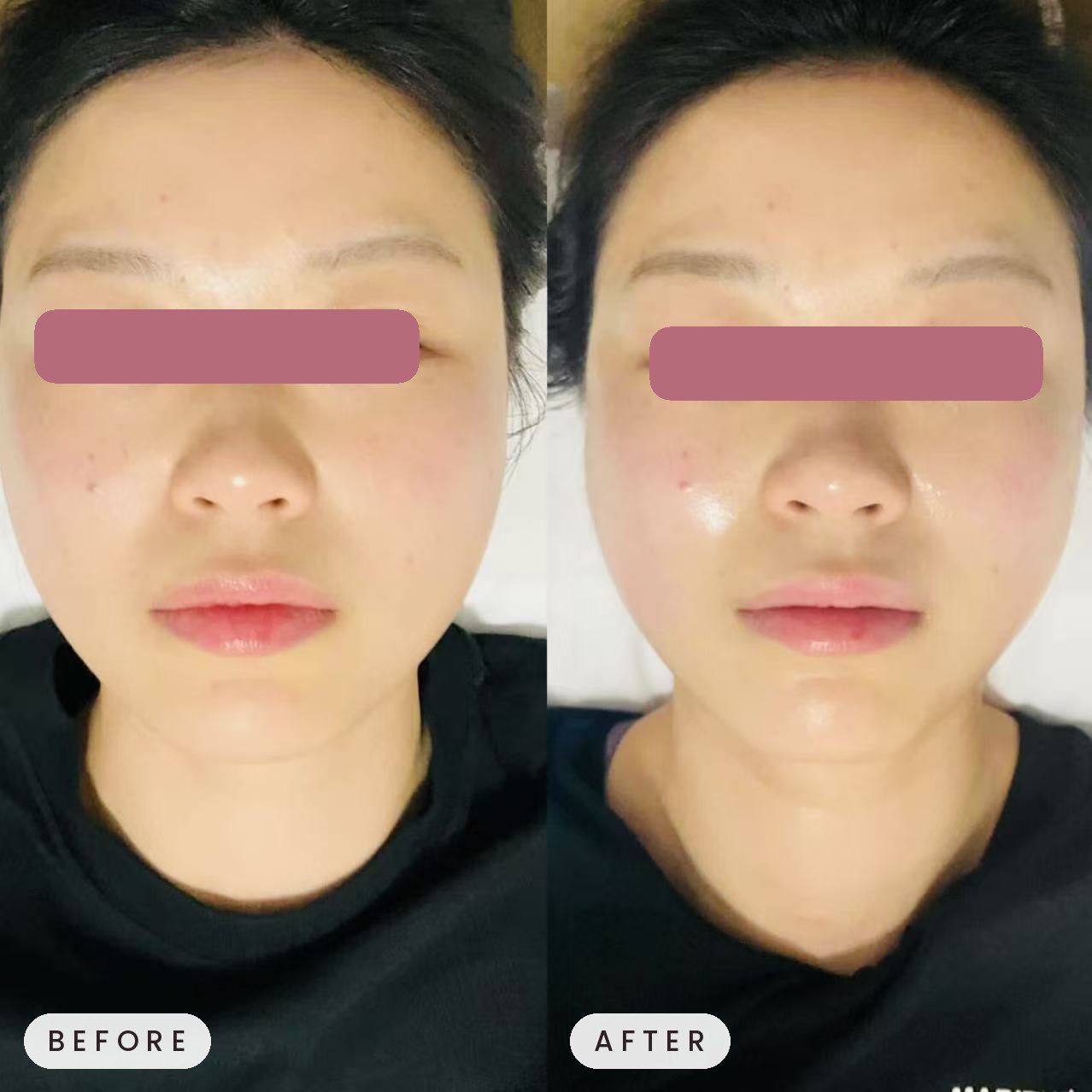 Onda facial contouring before and after