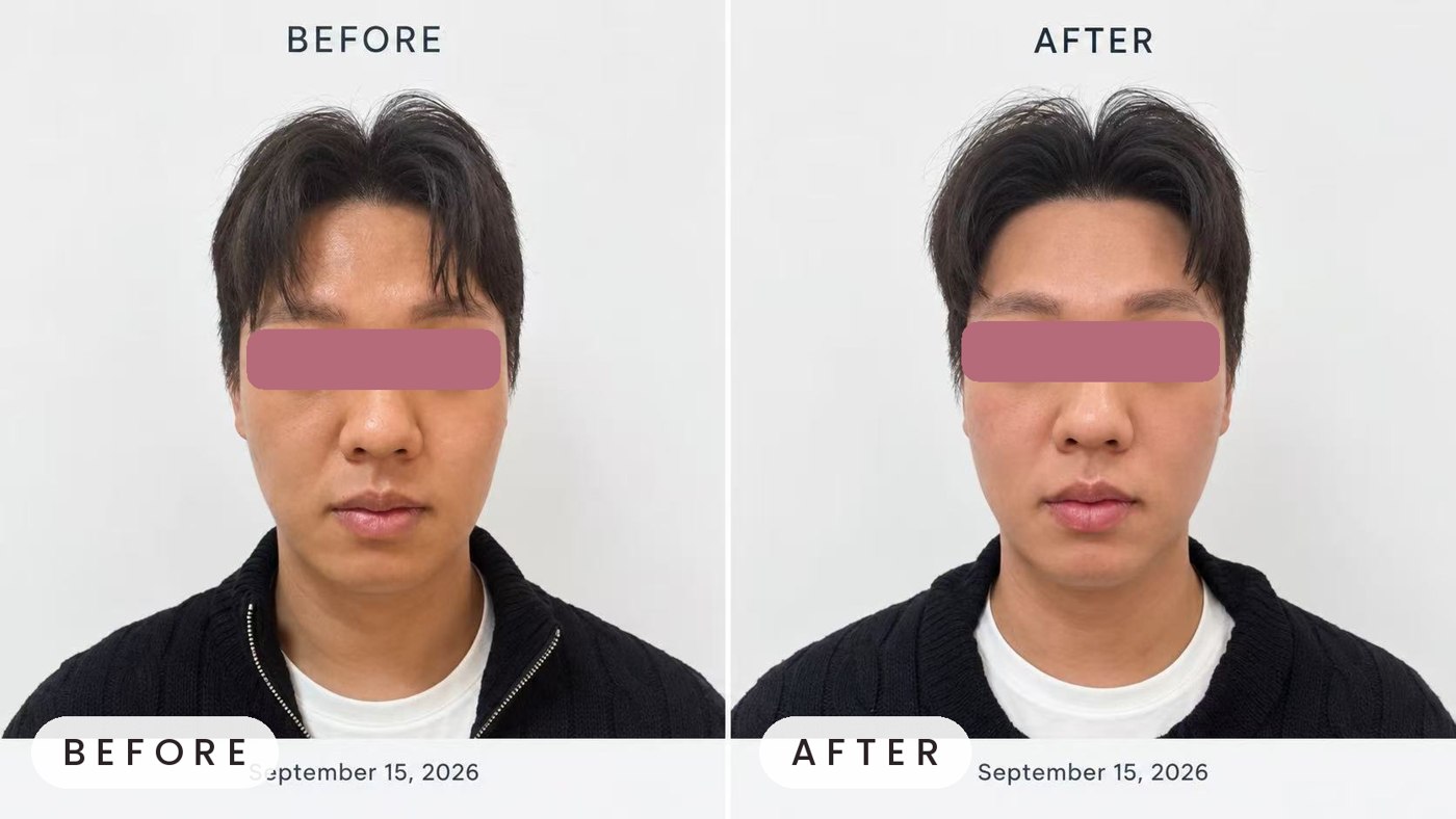 Onda facial contouring for men before and after